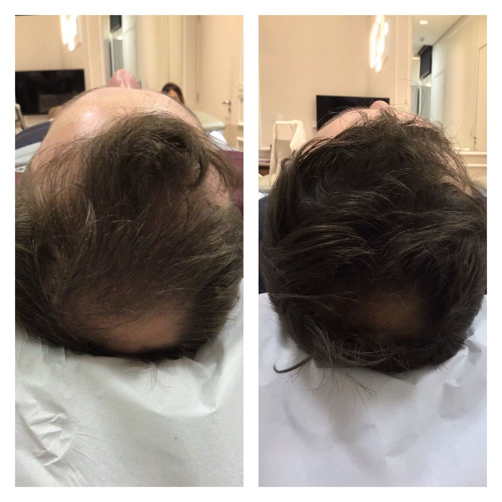 Evolução de tratamento de alopecia androgenética masculina