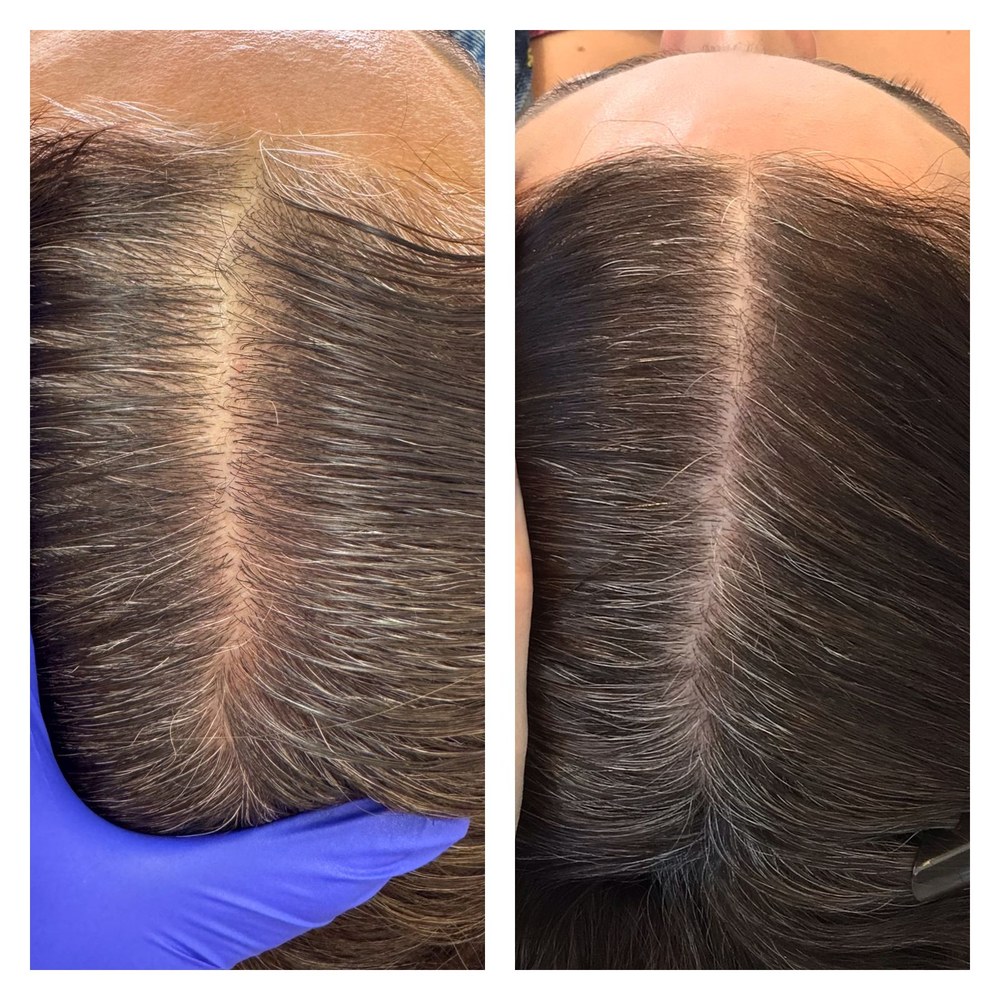 Evolução de tratamento de alopecia masculina